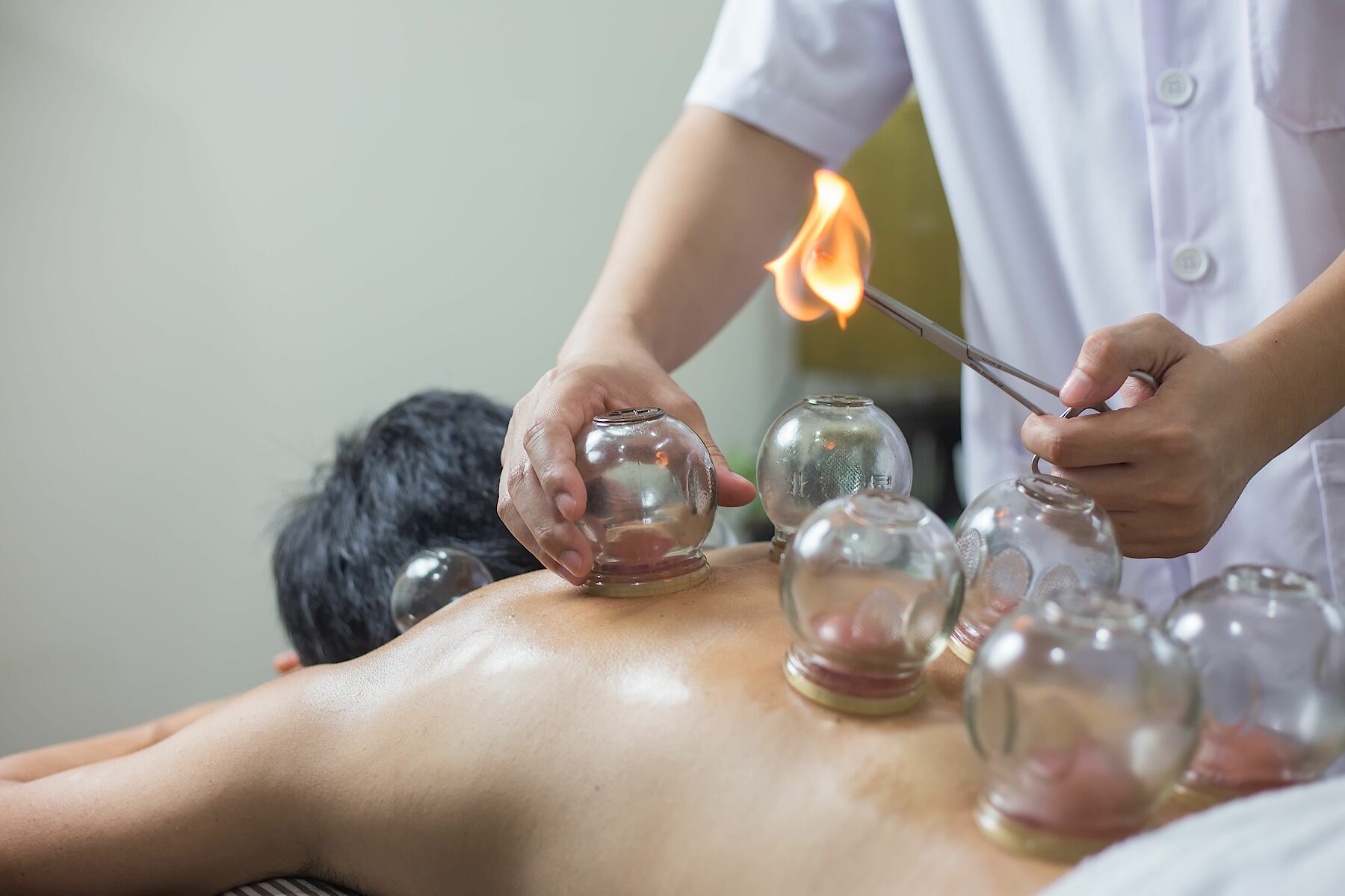 A Traditional Chinese Medicine practitioner performing cupping therapy, one of the ancient healing techniques shared with Māori volunteers during the Eastern Bridge exchange programme in Sichuan